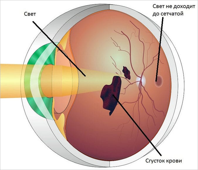 Поразка сітківки ока