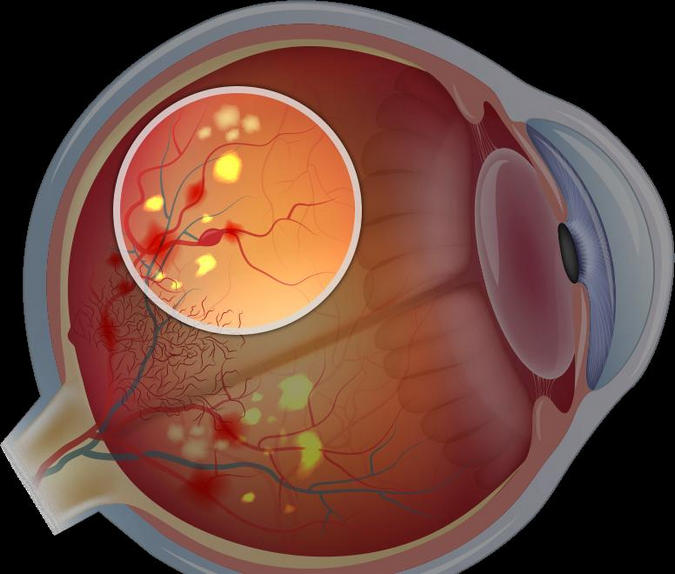Поражение сетчатки глаза лечение