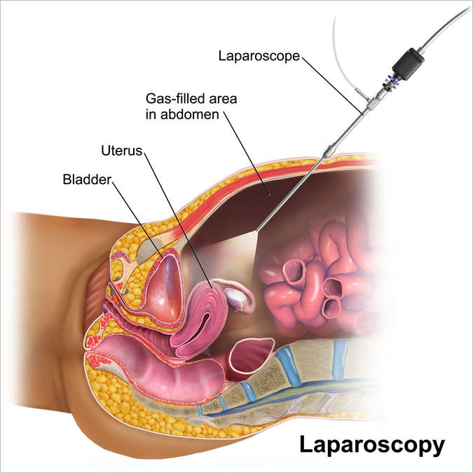 лапароскопія
