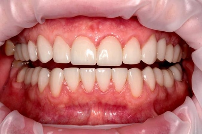 Имплантация зубов верхней и нижней челюсти