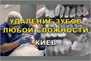 Нужно ли удалять зубы мудрости?